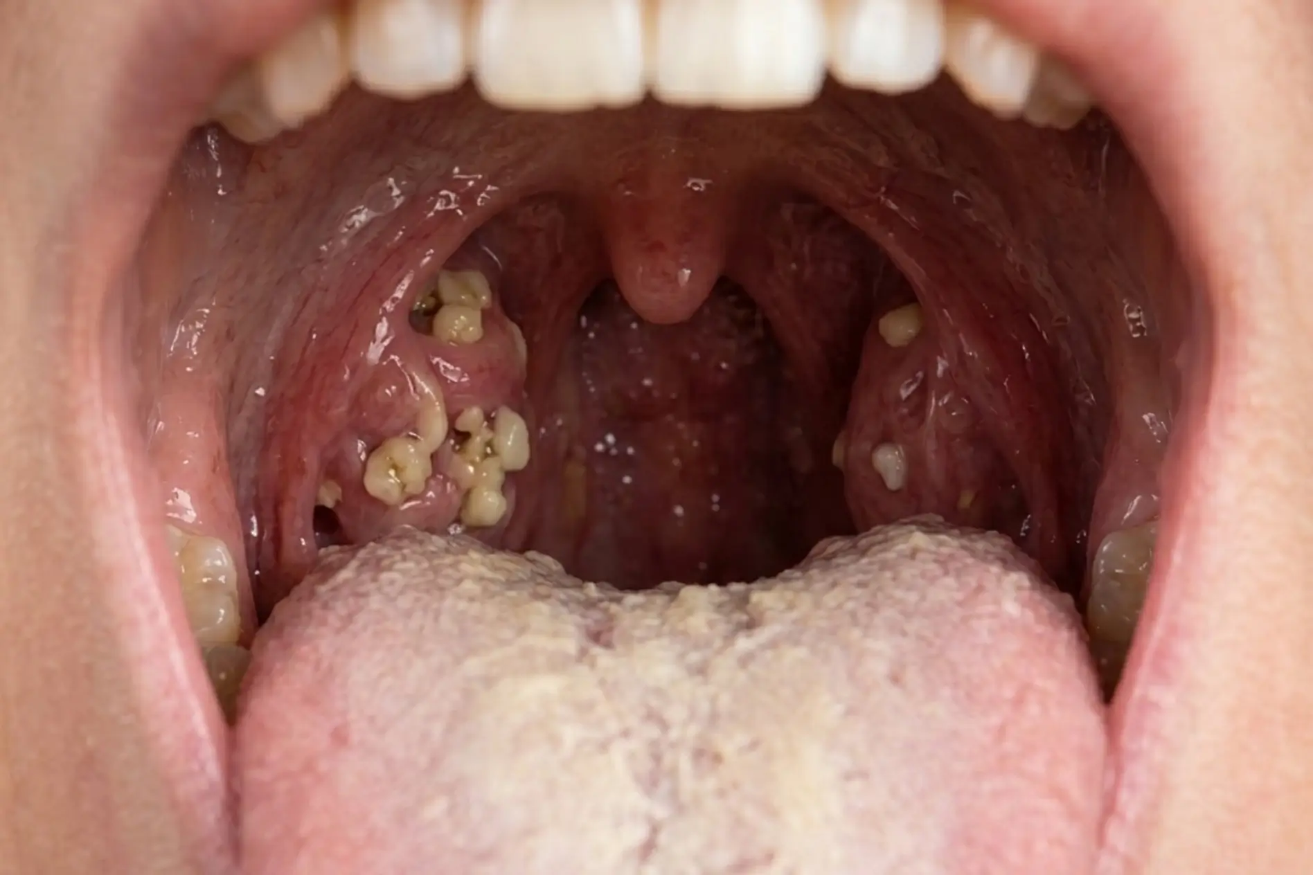 Cáseos Amigdalianos: O Que São, Por Que Causam Mau Hálito e Como Eliminar